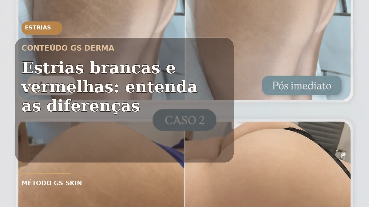Comparação visual de estrias e conteúdo educativo GS Derma sobre estrias brancas e vermelhas