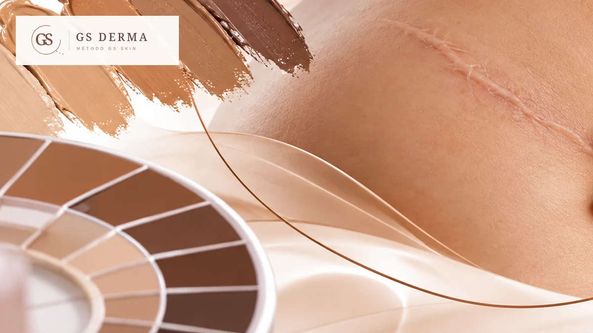 Imagem editorial GS Derma sobre correspondência de tons de pele e camuflagem de cicatriz.