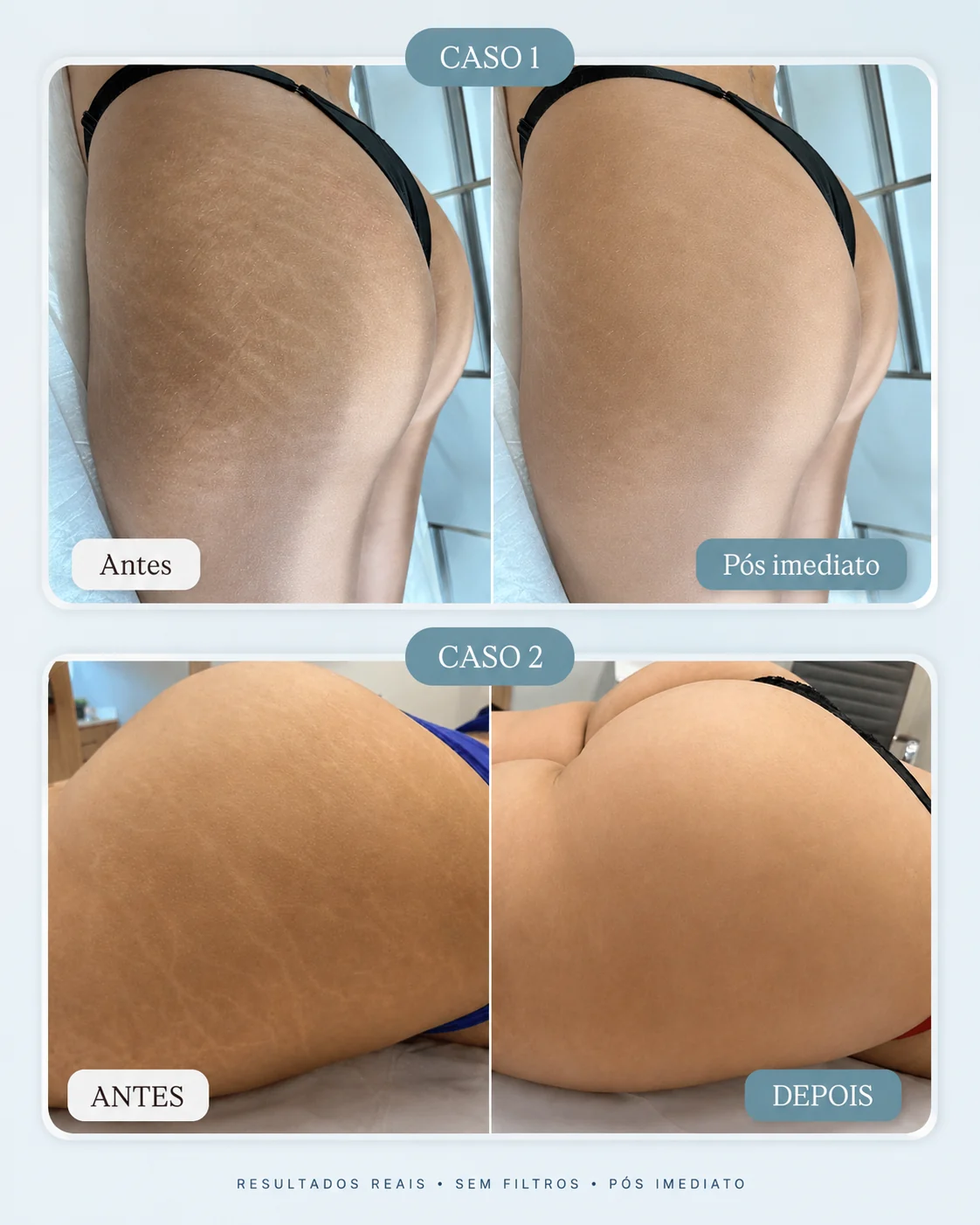 Antes e depois de estrias em região corporal