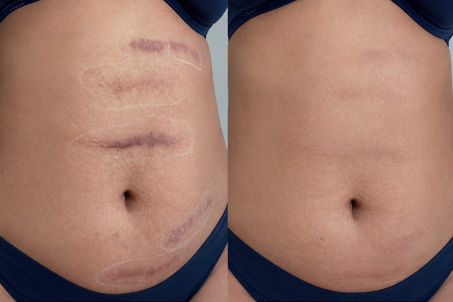 Antes e depois de estrias em região corporal
