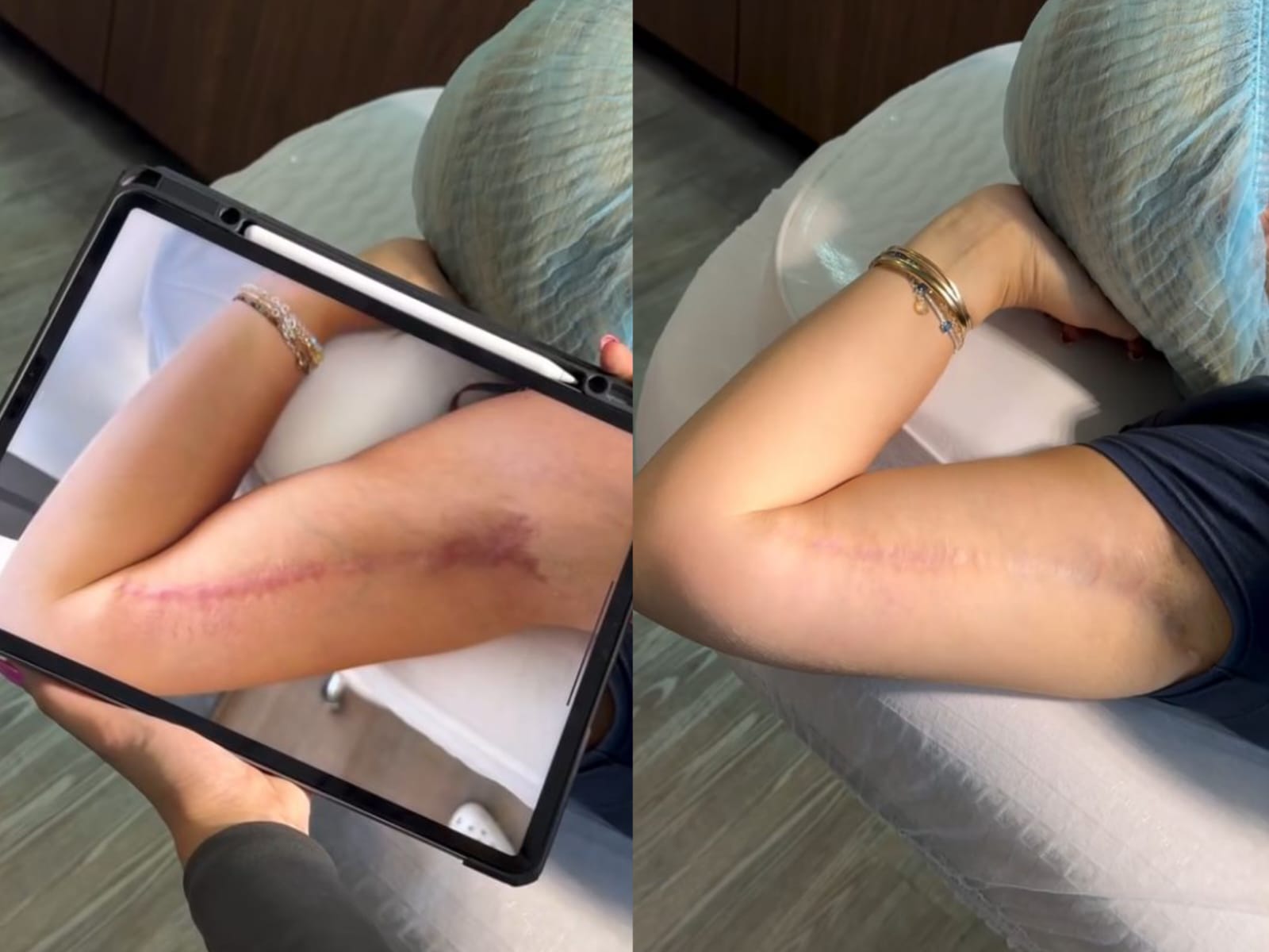 Antes e depois de estrias em região corporal