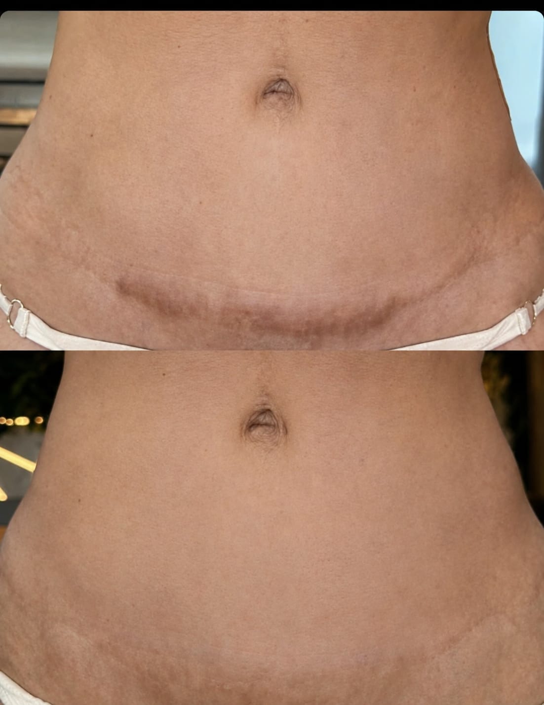Antes e depois de cicatriz abdominal