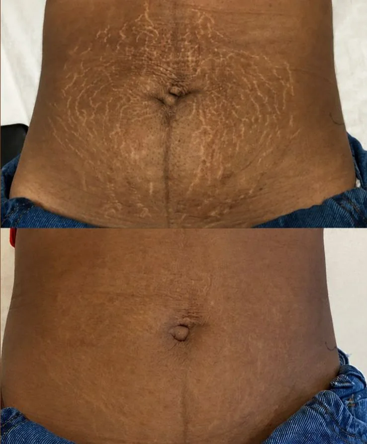 Resultado antes e depois em estrias no abdômen