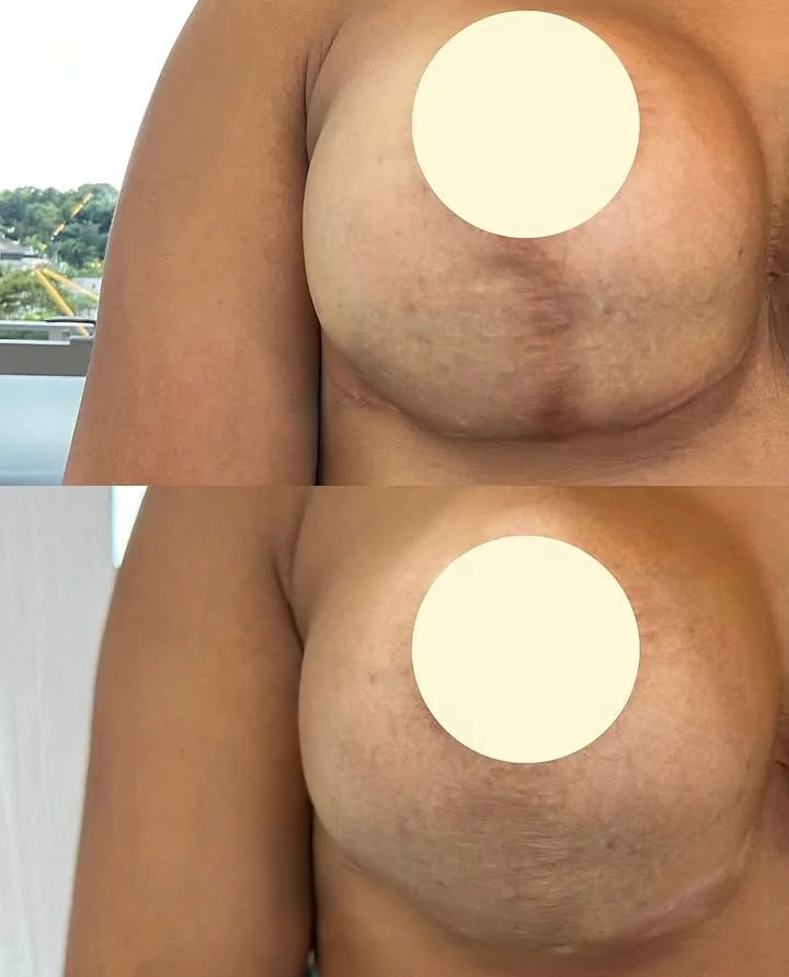 Resultado antes e depois em estrias abdominais