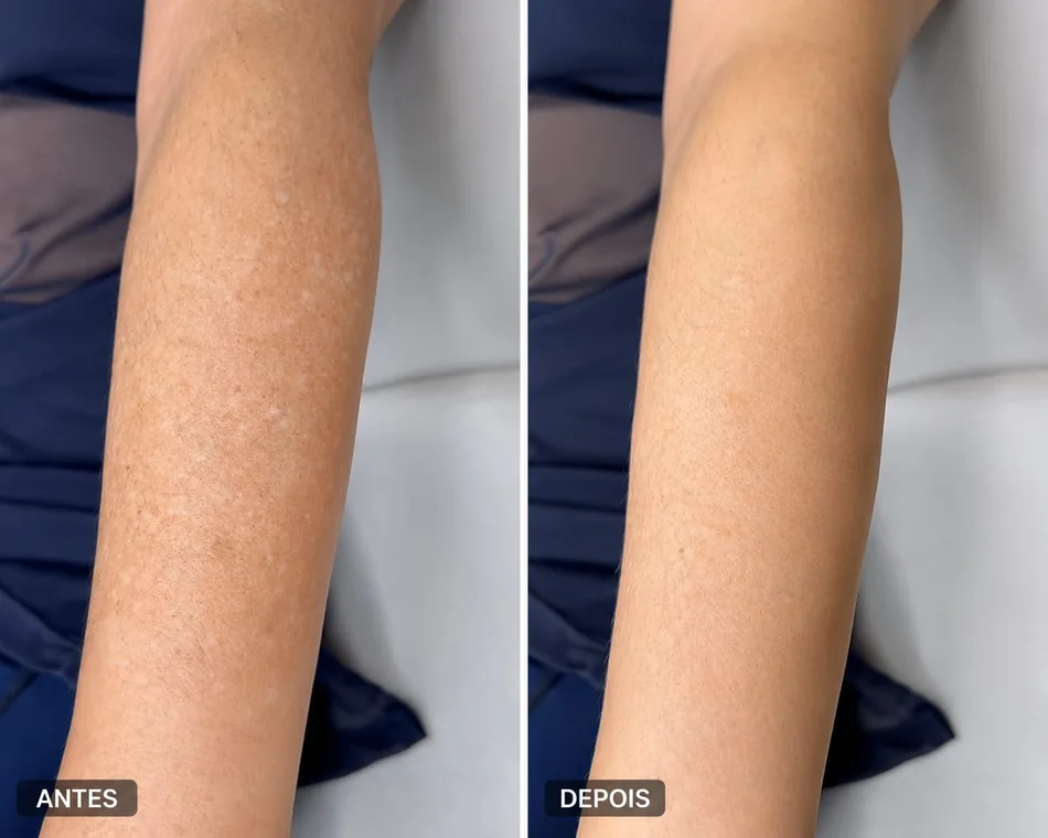 Resultado antes e depois em manchas no braço